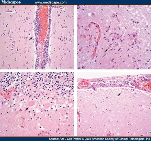 Демодекс - Причины Демодекса - Симптомы Демодекса - ceshawkfrenin