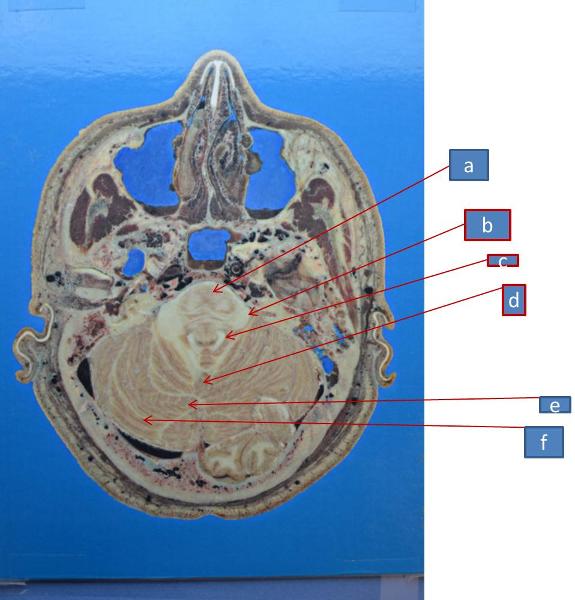 Print Neuro Lab Block III MRIs and Brain Sections flashcards | Easy