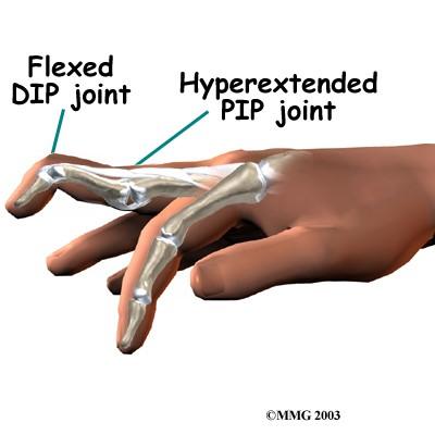 Health Conditions hand anatomy vs arthritis Flashcards | Easy Notecards