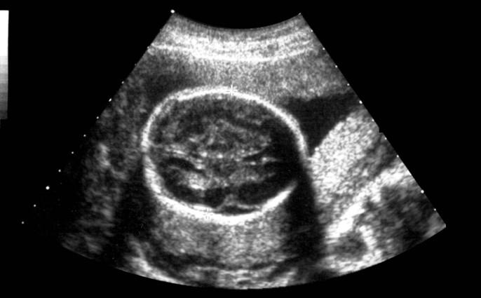 Ultrasound Physics Chapter 8 & 9 Flashcards | Easy Notecards