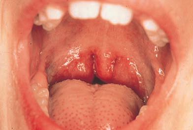Large White Patch On Tonsils
