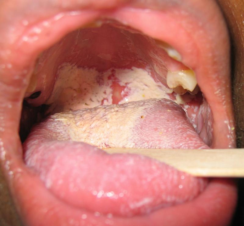 Aids White Spots In Mouth 28