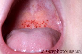Tiny Dark Red Spots On Back Of Throat 24