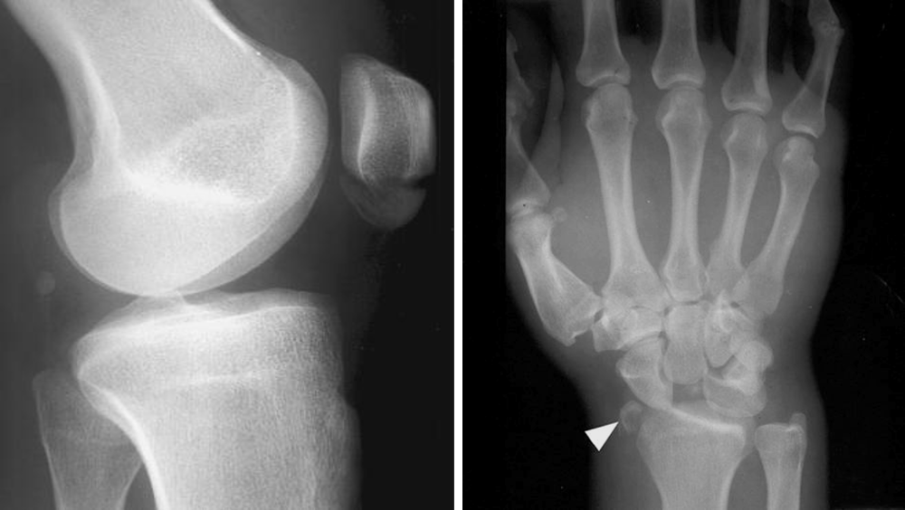 What Causes Wrist Bone To Stick Out