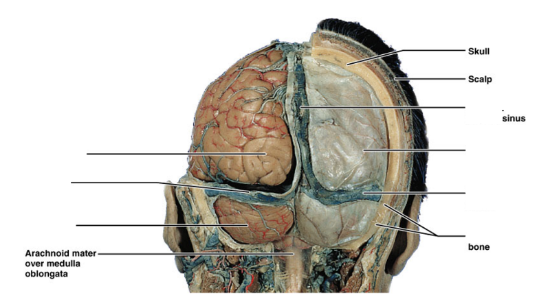 Print ventricles, meninges, CSF and blood vessels of the brain