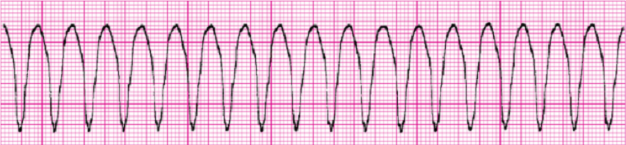 желудочковая тахикардия без пульса на экг. экг синусовая тахикардия 150. фибрилляция желудочков на экг. тахикардия без пульса. фибрилляция желудочков без пульса.