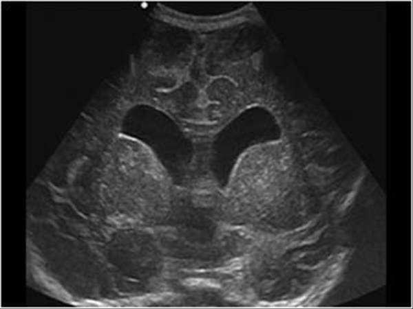 Neonatal Head Ultrasound