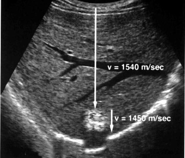 Ultrasound Range Ambiguity Artifact Ultrasound Imaging Artifacts: How