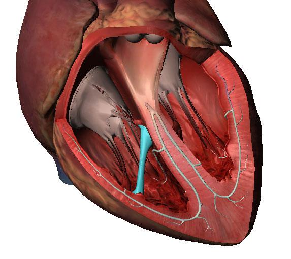 Наличие хорды у человека. Дополнительная трабекула левого желудочка сердца. Хорда в желудочке сердца. Дополнительная хорда в сердце. Трабекулы желудочков сердца.
