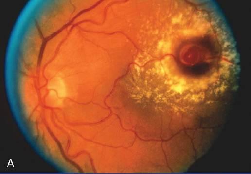 Print Ophtho Lesson 7 Ocular Manifestations of Systemic Disease